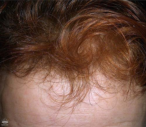 Gehele haar oppervlakte na haartransplantatie