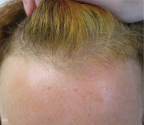 Gehele haar oppervlakte voor haartransplantatie