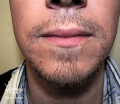 Haartransplantatie baard na behandeling