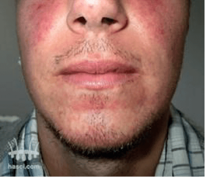 Haartransplantatie baard voor behandeling