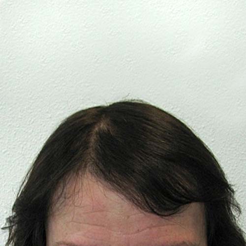 Haartransplantation bei Frauen nach der HST-Methode