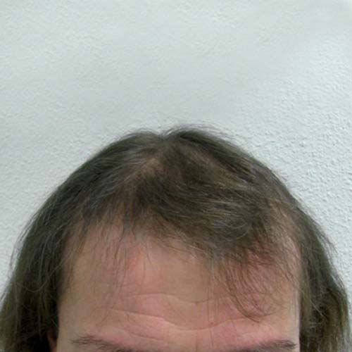 Haartransplantation bei Frauen zur HST-Methode