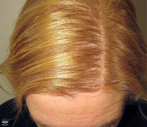 Haarausfall bei Frauen nach Haartransplantation