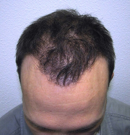 Haaransatz nach Haartransplantation