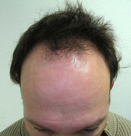 Haaransatz zur Haartransplantation