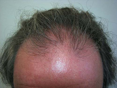 Patientenbezogenes Ergebnis für die Haartransplantation