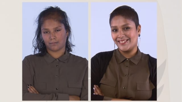 voor en na foto's vooraanzicht van Indrani deelneemster in Lelijke eendjes haartransplantatie