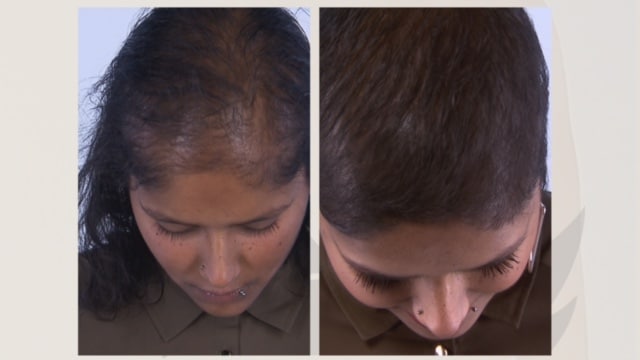 Voor en na fotos lelijke eendjes Indrani haartransplantatie