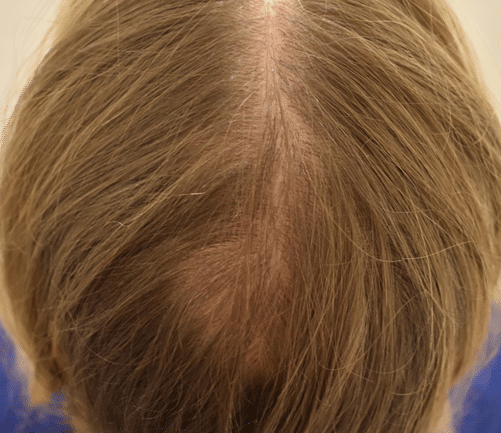Narbe nach Haartransplantation