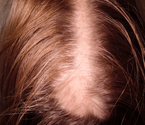 Narbe für Haartransplantatio